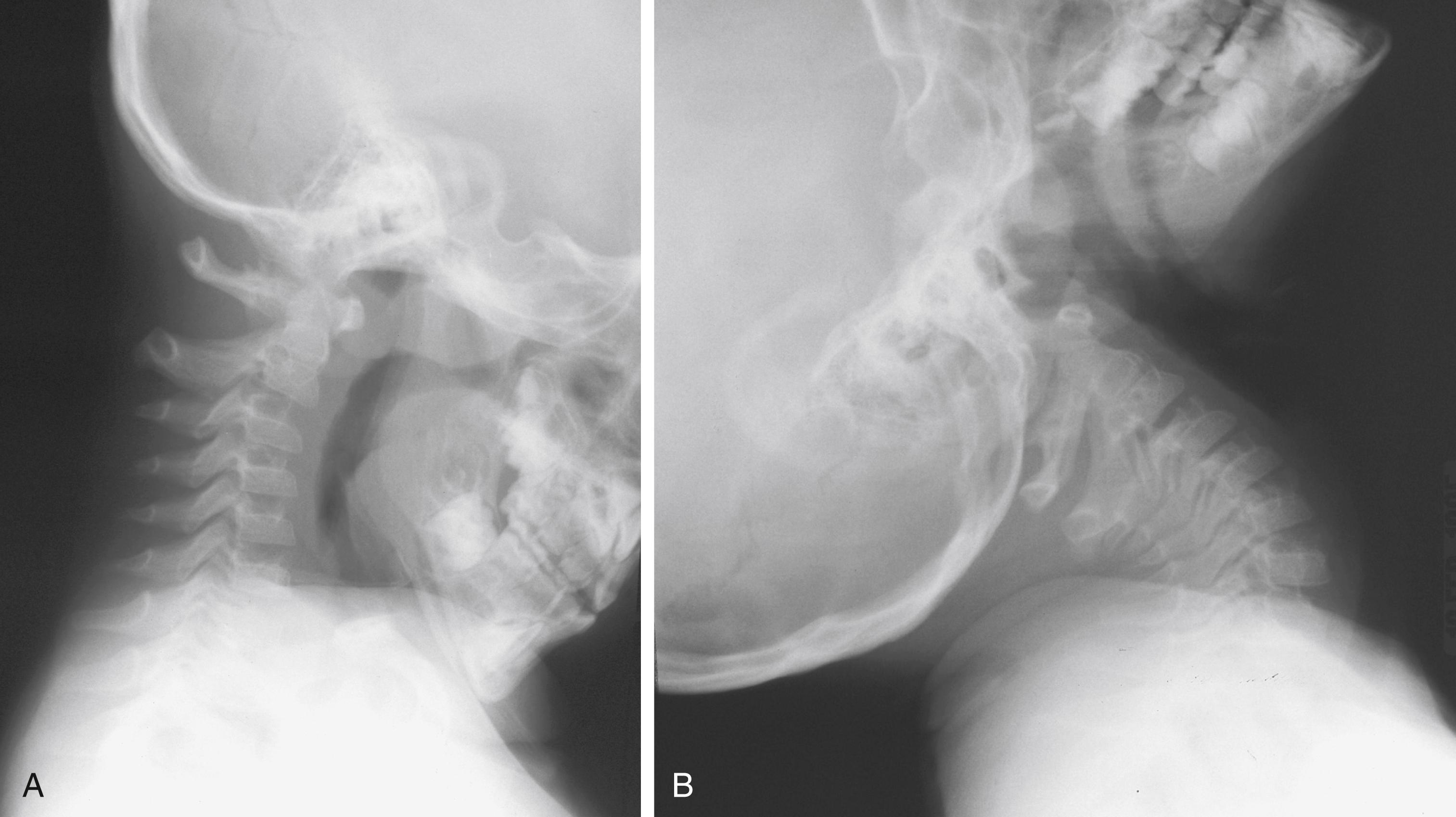 Spinal Injuries - Clinical Tree