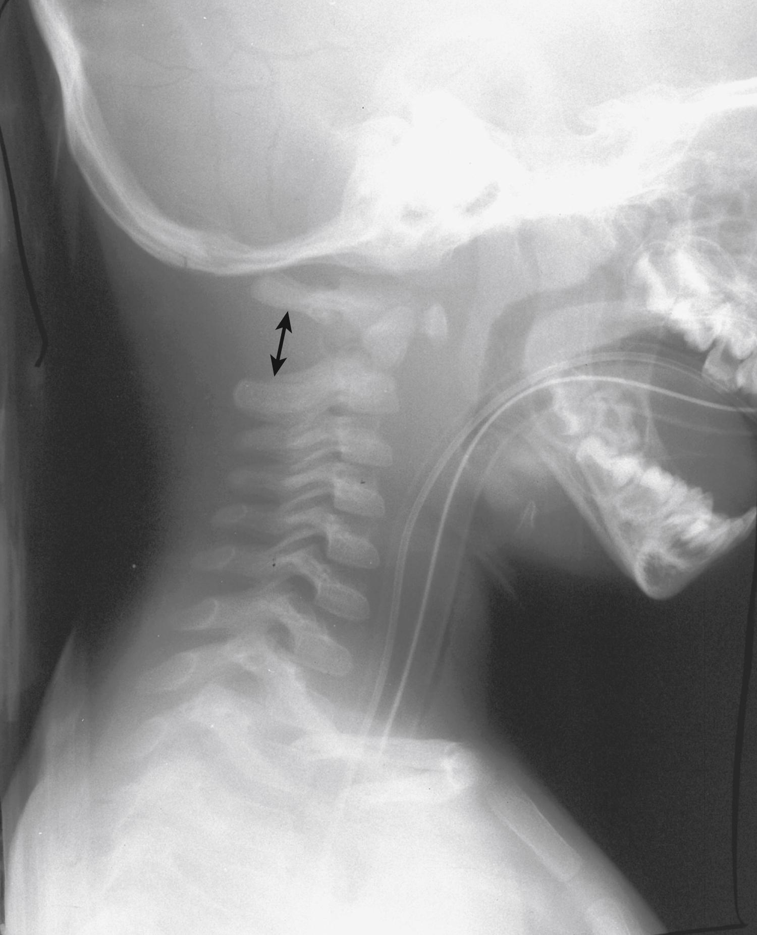 Fig. 28.6, Posterior ligamentous instability. A lateral radiograph of a 2-year-old child demonstrates widening of the posterior elements between C1 and C2 (arrow) , indicating a posterior ligamentous injury.