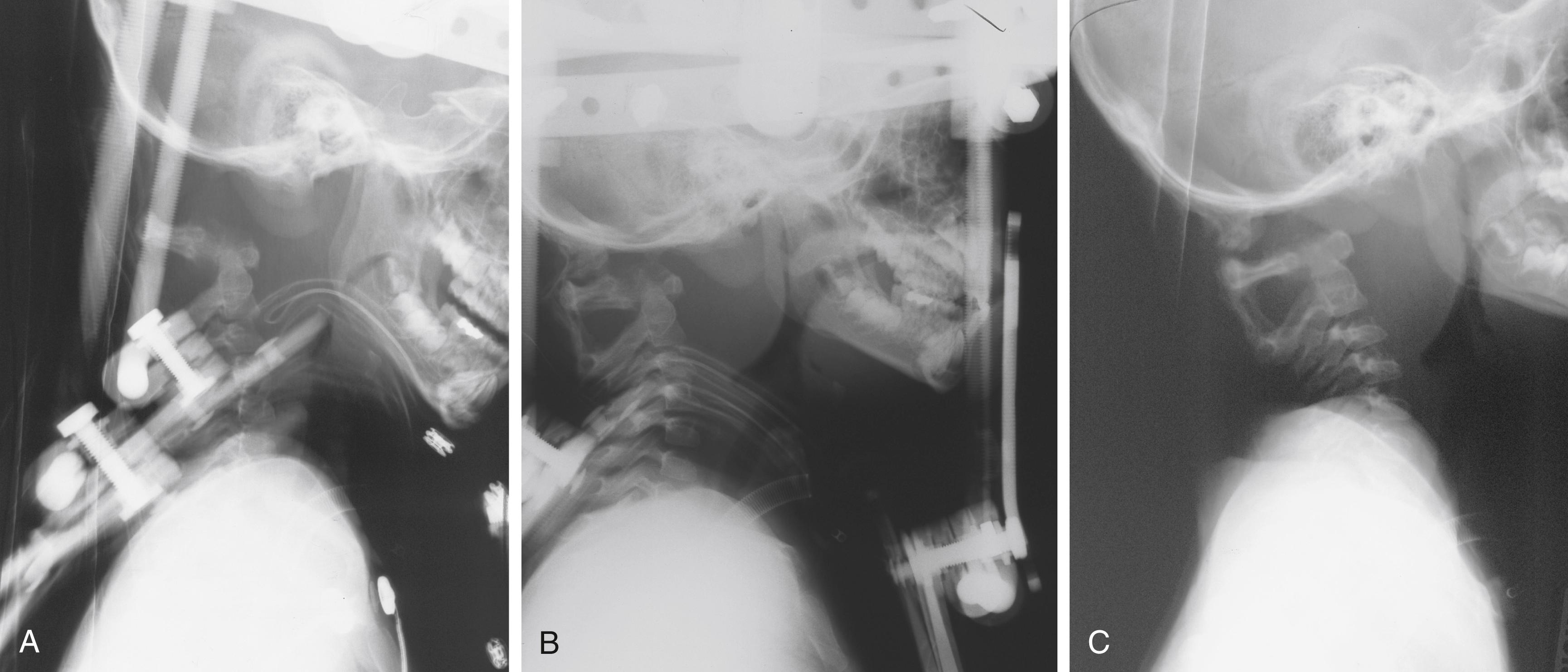 Fig. 28.10, Treatment of atlantooccipital dislocation. (A) Lateral radiograph demonstrating atlantooccipital dislocation. (B) Lateral radiograph obtained after halo application with reduction. (C) Lateral radiograph demonstrating fusion 4 months after injury and fusion from the occiput to C2.