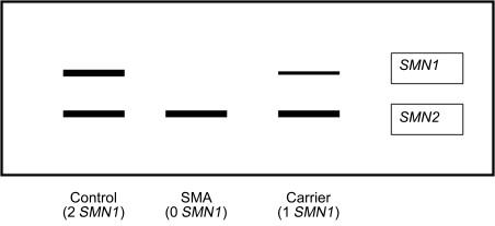 Figure 8.3, PCR diagnosis of SMN1 deletion. PCR-based targeted mutation analysis using a restriction enzyme that digests exon 7. In a patient with a homozygous deletion of exon 7, the restriction fragment is absent (0 copies of SMN1 ). In a carrier (heterozygous deletion), a lighter SMN1 band will be present. Similar targeted mutation analysis can also be performed with multiplex ligation probe amplification methodology.