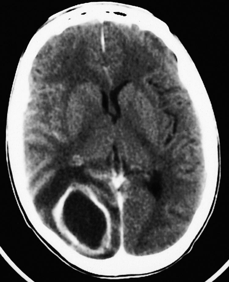 Figure 60.1, This computed tomography scan demonstrates a low-density mass lesion with an enhancing rim and surrounding edema in an immunosuppressed patient with an Aspergillus abscess. Lumbar puncture in such a patient would be contraindicated.
