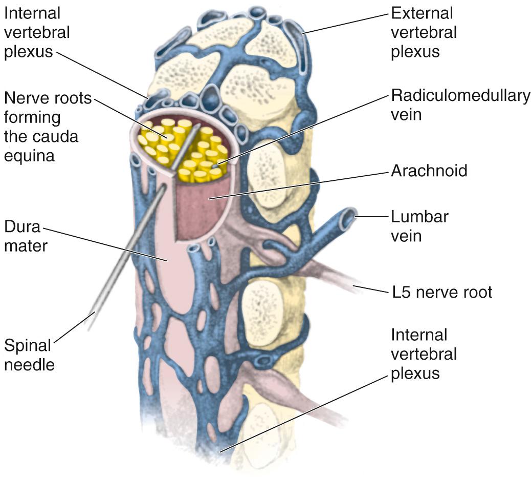 Figure 60.11, The spinal contents at L4 and L5 show the relationship of a lumbar puncture needle to the major vessels at this level. The major radiculomedullary vein, shown accompanying the L5 nerve root, is situated far lateral to a needle correctly positioned in the midline of the dural sac. Note the avascular subdural space.