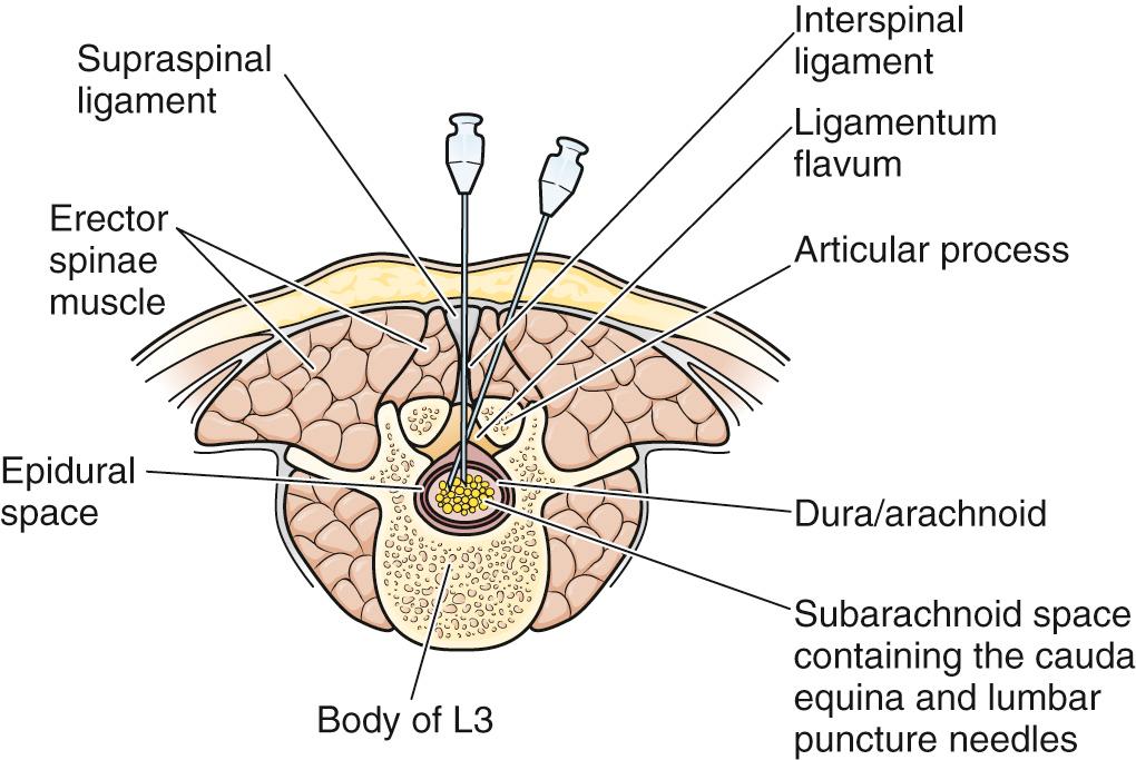 Figure 60.12, Horizontal section through the body of L3. Note the two puncture needles in the subarachnoid space. The medial needle is in the midline. The lateral needle exemplifies the lateral approach, which avoids the occasionally calcified supraspinal ligament. Note the lateral needle piercing the intrinsic musculature of the back and only one ligament, the ligamentum flavum.