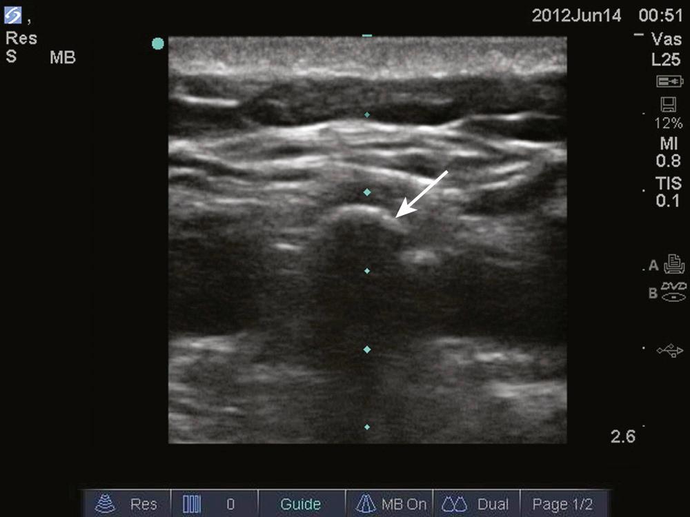 Figure 60.US1, Transverse image of the lumbar spine. The crescent-shaped hyperechoic structure (arrow) is a spinous process. Note the presence of posterior acoustic shadowing. Align the probe so that the spinous process is directly centered in the image. The general symmetry of the image provides additional assurance that the probe is centered correctly.
