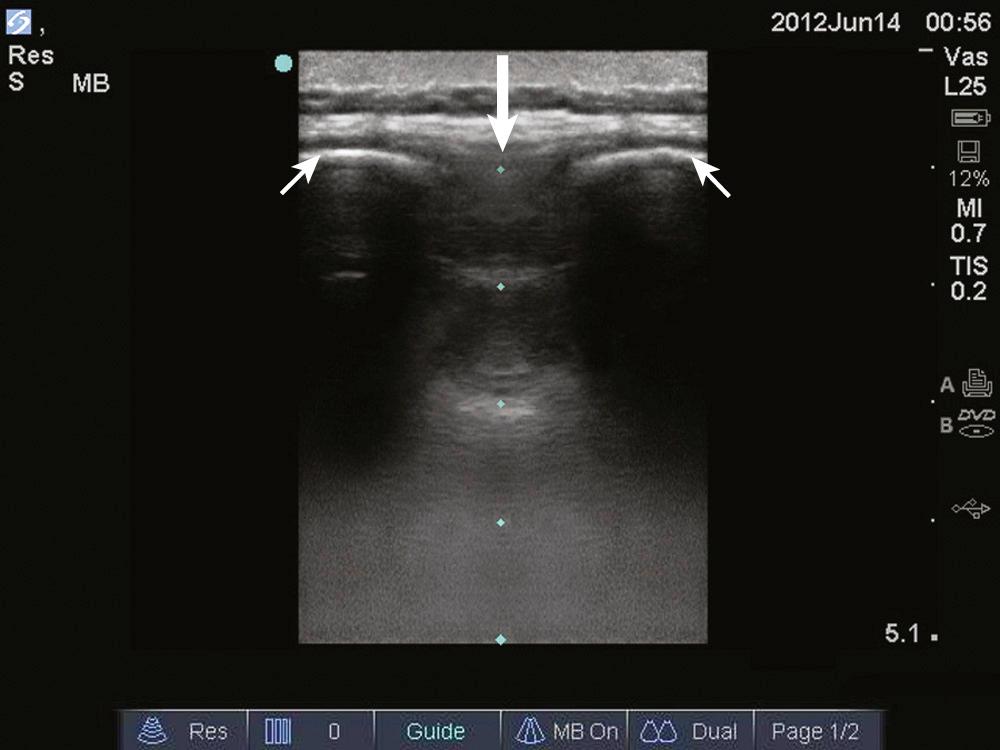 Figure 60.US2, Longitudinal image of the lumbar spine. The spinous processes (small arrows), are visible again, and appear as crescent-shaped hyperechoic structures with acoustic shadowing. In between each spinous process is the interspinous space (large arrow). Note how this space is bordered on either side by the acoustic shadow of the spinous process. Note also how the probe is centered directly over the interspace.