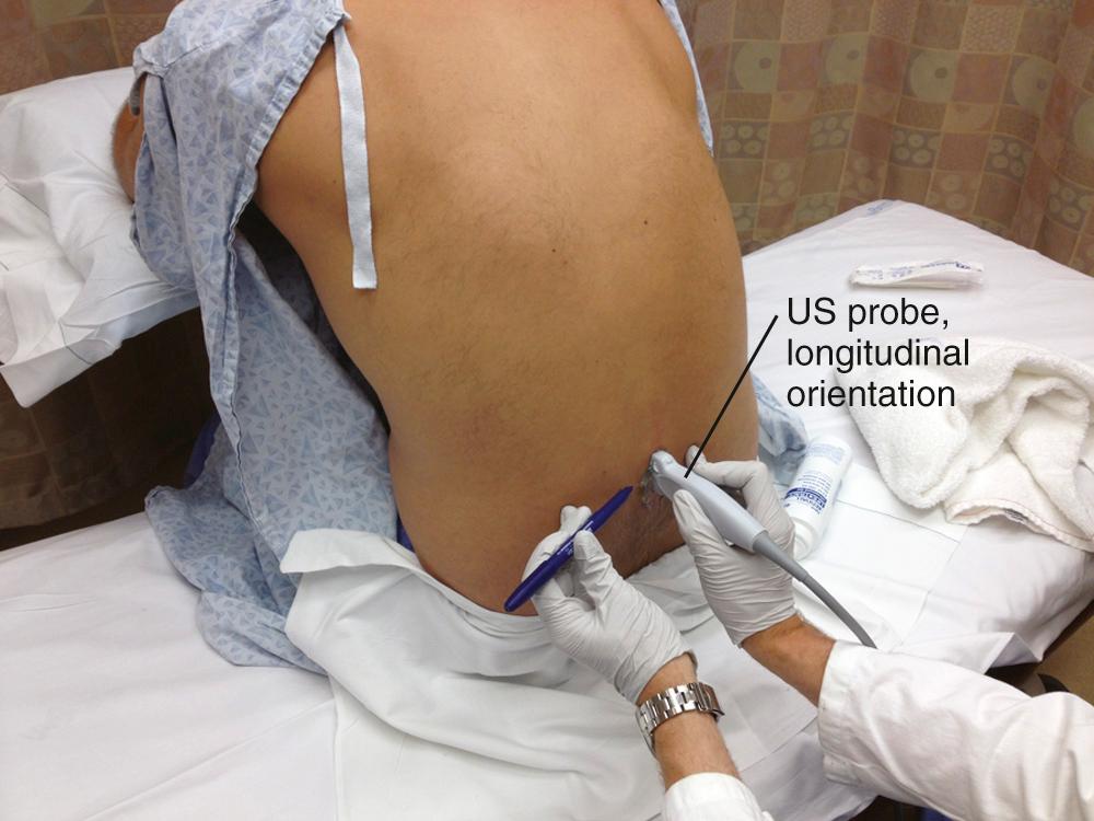 Figure 60.US4, Rotate the ultrasound (US) probe 90 degrees and obtain a midline longitudinal view. Position the probe so that the interspace is centered on the screen (as in Fig. 60.US2 ). Mark the skin at the midpoint of the transducer. This represents the level of needle entry.