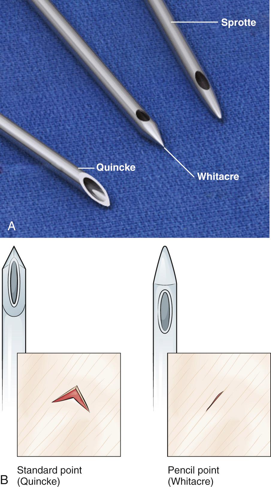 Figure 60.2, A, Various spinal needles. B, Penetration of the dura by Whitacre (pencil-point) and Quincke (cutting) needles. The Whitacre needle separates the fibers of the dura without cutting them, whereas the Quincke needle cuts the fibers. The Quincke needle leaves a hole in the dura through which cerebrospinal fluid can leak until the hole heals several days or weeks later. Use of the Whitacre needle has been associated with a lower incidence of post-lumbar puncture headache.
