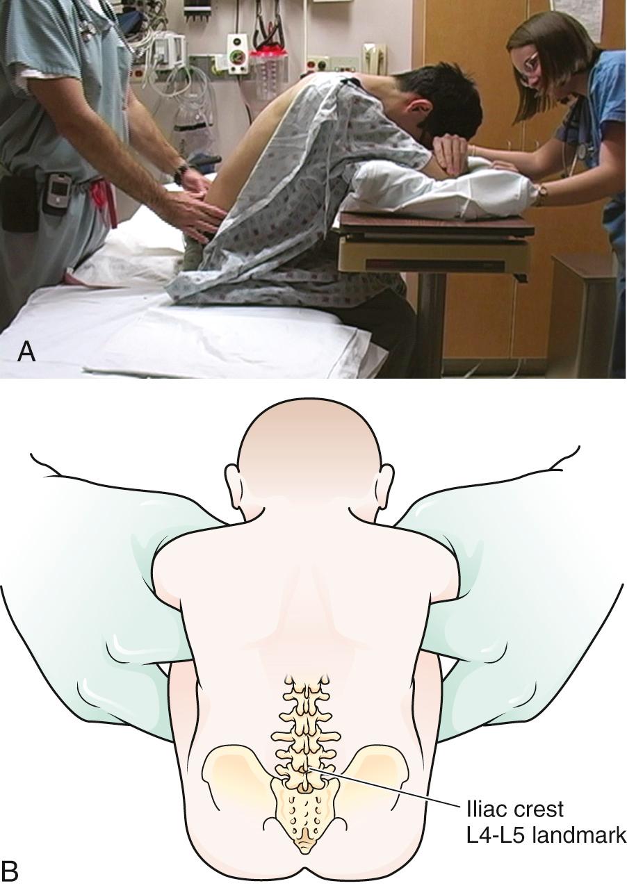 Figure 60.5, A, Many clinicians prefer the sitting position for lumbar puncture because of the ease of entering the dural space. However, the opening pressure obtained in this position is not accurate. If possible, place the patient in the lateral decubitus position for measurement of pressure, usually after fluid has been collected. B, Upright positioning in an infant.