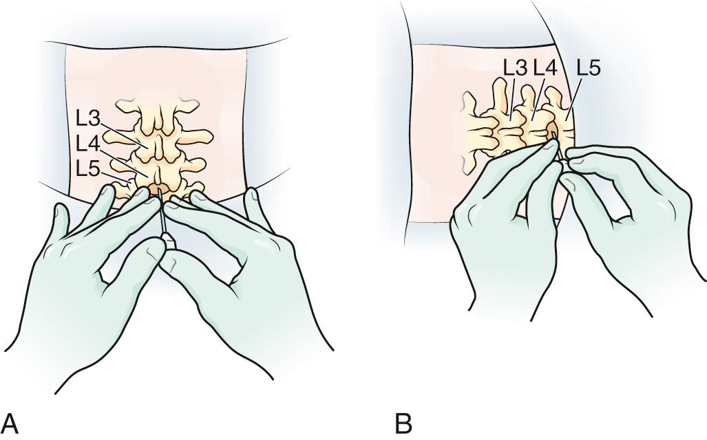 Figure 60.6, Various ways to hold the spinal needle.