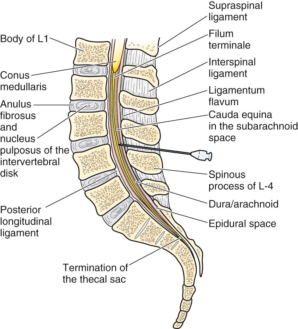 Figure 60.7, Midsagittal section through the lumbar spinal column with a spinal puncture needle in place between the spinous processes of L3 and L4. Note the slightly ascending direction of the needle. The needle has pierced three ligaments and the dura/arachnoid and is in the subarachnoid space.