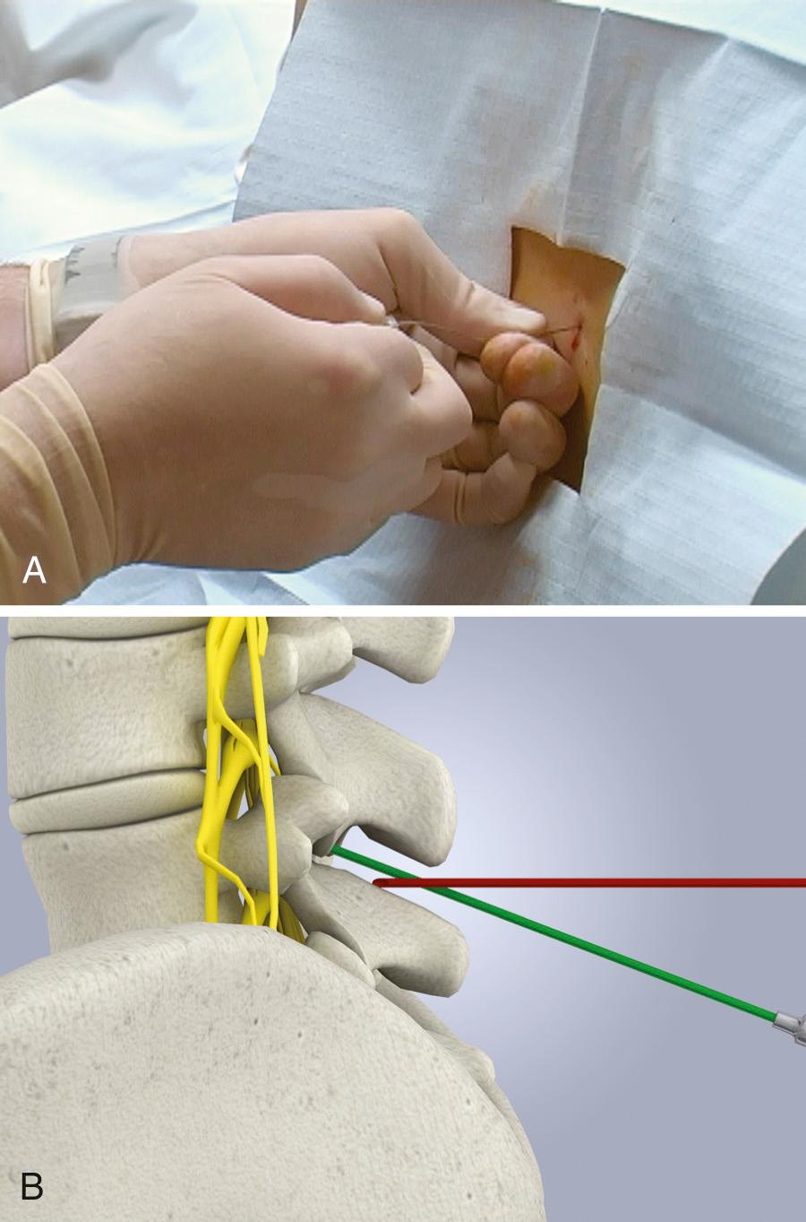 Figure 60.8, A, This 22-gauge spinal needle has struck bone during advancement (notice the bend in the needle) and needs to be repositioned. B, If bone is encountered, it is usually the inferior spinous process (red spinal needle). The needle must be partially withdrawn into subcutaneous tissue and then readvanced in a more cephalad direction (green needle).