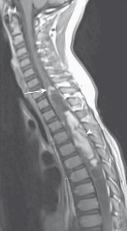 Figure 45.1, Astrocytoma in an 8-year-old boy with back pain.