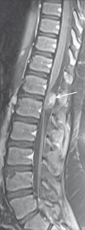 Figure 45.3, Ependymoma in an 11-year-old boy with unexplained altered mental status.