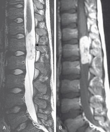 Figure 45.4, Myxopapillary ependymoma in an 11-year-old girl with back pain.