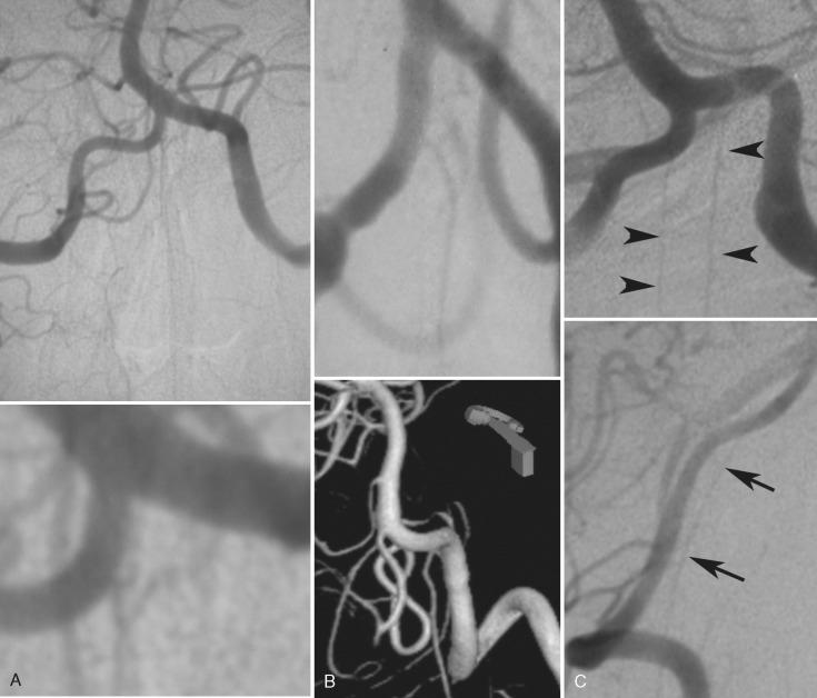 FIGURE 8-1, The origin of the anterior spinal artery from the vertebral artery varies. It may arise from one or both vertebral arteries. Its junction in the midline is variable, ranging from early fusion in the anterior sulcus to a long unfused segment along the anterior surface of the cord. A , “Classic” textbook appearance of a bilateral supply to the anterior spinal artery with a proximal fusion along the midline. B , Unilateral supply to the anterior spinal artery. C , Bilateral unfused supply to the anterior spinal artery in AP ( arrowheads ) and lateral ( black arrows ) views.