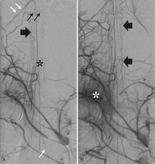 FIGURE 8-3, At various, unpredictable levels, flow within the anterior spinal artery is reinforced by additional metameric arterial supply. In this young patient with suspected arteriovenous malformation, injection of the right segmental artery at the T4 level ( A : early arterial, B : late arterial phase) displays the anterior spinal artery, its division into superior and inferior branches ( A , black asterisk ), and retrograde filling of additional feeders both superior and inferior to the T4 level ( A , white arrows ). In addition, radiculopial arteries ( thick black arrows ) fill via an extensive collateral supply with longitudinal and transverse paravertebral anastomoses and via the anastomotic network of the vasocorona ( A , small black arrows ). The level of the injected segmental artery can be deduced from the extensive vertebral blush ( B , white asterisk ).