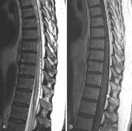 FIG 33-1, Spinal dural AVF in a 56-year-old man. Spinal cord edema with breakdown of blood–spinal cord barrier is demonstrated as hyperintensity on T2 ( A ) and patchy enhancement on postcontrast T1 ( B ). Dilated perimedullary veins on the dorsal surface of spinal cord can be seen as multiple serpentine flow voids ( arrows on A and B ) on T2 ( A ) and enhancements on postcontrast T1 ( B ).