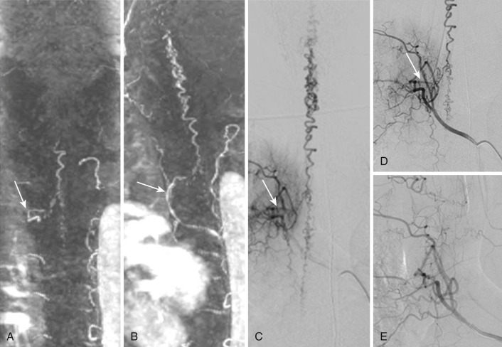 FIG 33-2, Spinal dural AVF in a 53-year-old man. Contrast-enhanced spinal MR angiograms ( A, B ) can show the level and feeding artery of the fistula and thereby direct the subsequent catheter angiogram ( C, D ). The arrows mark the transition between the artery and the veins (i.e., the fistulous zone). After embolization with glue, the shunt was completely obliterated ( E ).