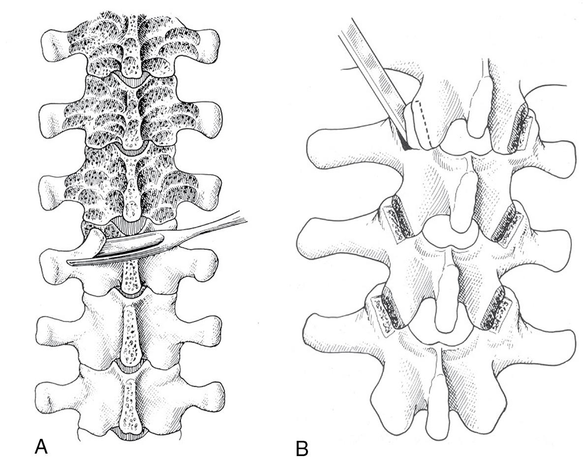 Fig. 25.1, Posterior spinal arthrodesis technique. (A) Posterior fusion. Posterior osseous structures (lamina, facet joints, transverse processes) are cleaned of soft tissue, and the outer cortical bone is removed (decortication) to expose underlying cancellous bone. (B) Facet joint fusion. The facet joint cartilage is excised, and the joint surfaces are prepared for bone graft application.