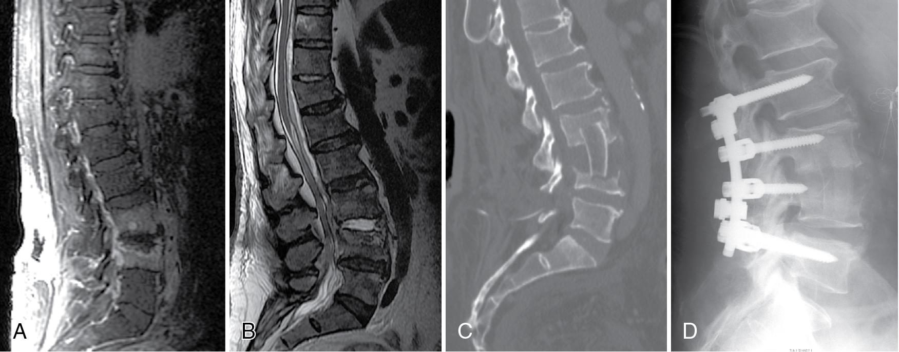 Fig. 66.1, A 60-year-old man with severe low back pain.