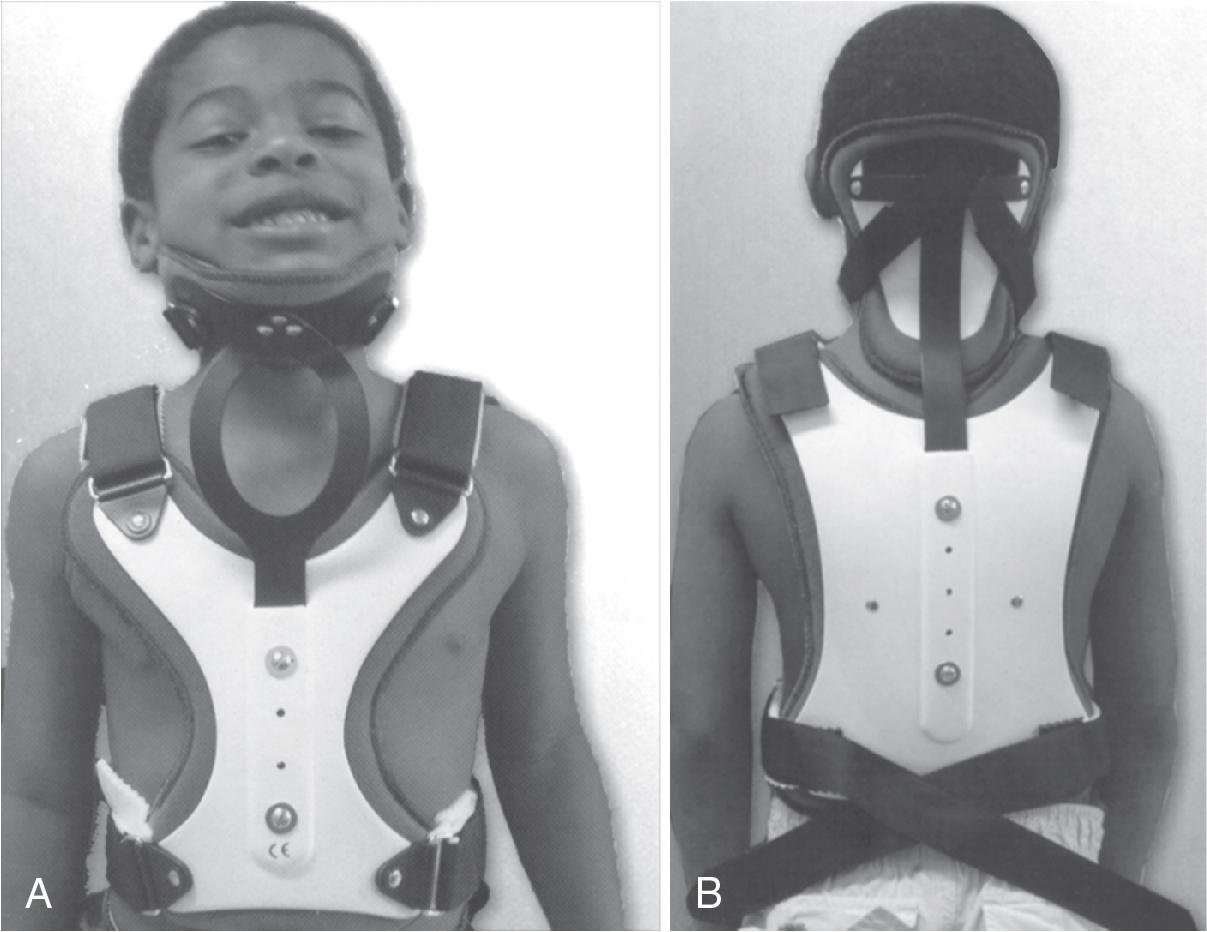 Fig. 18.8, Minerva cervicothoracic orthosis.