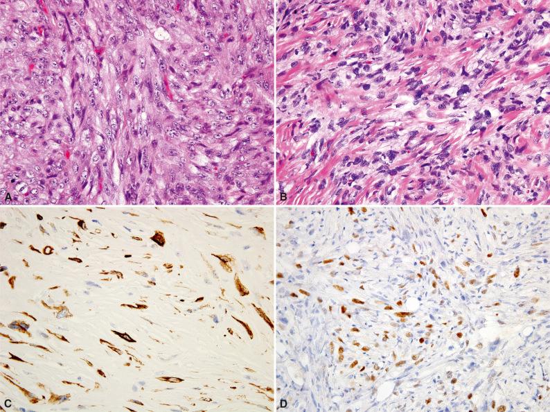 Figure 3.1, Spindle Cell (Sarcomatoid) Carcinoma.