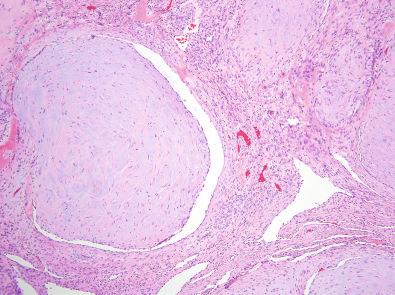 Figure 3.11, Myofibroma.