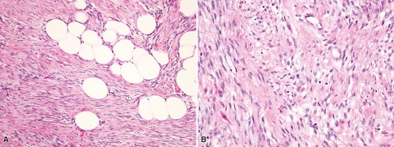 Figure 3.14, Mammary-Type Myofibroblastoma.