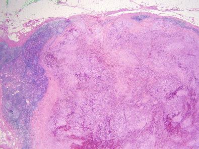 Figure 3.15, Intranodal Palisaded Myofibroblastoma.