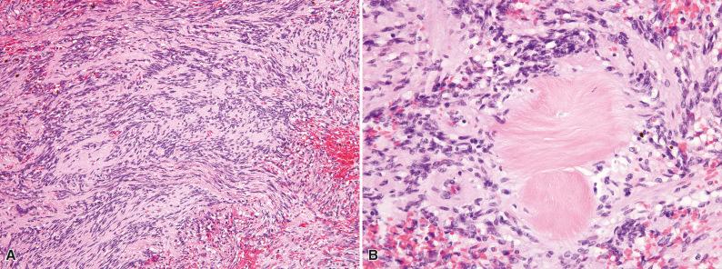 Figure 3.16, Intranodal Palisaded Myofibroblastoma.