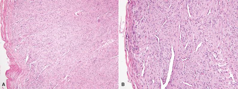 Figure 3.17, Fibroma of Tendon Sheath.