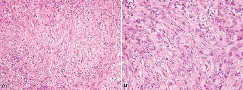 Figure 3.18, Fibroma of Tendon Sheath.