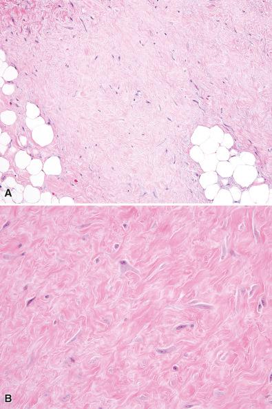 Figure 3.20, Desmoplastic Fibroblastoma.