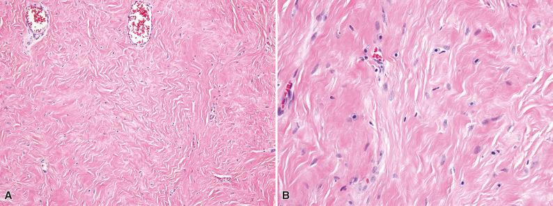 Figure 3.21, Nuchal-Type Fibroma.