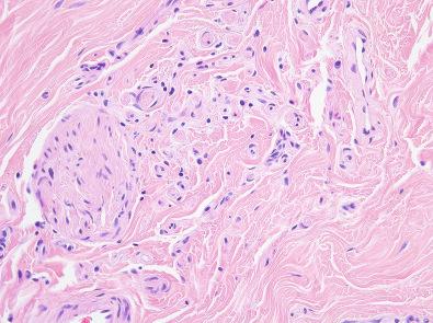 Figure 3.22, Nuchal-Type Fibroma.