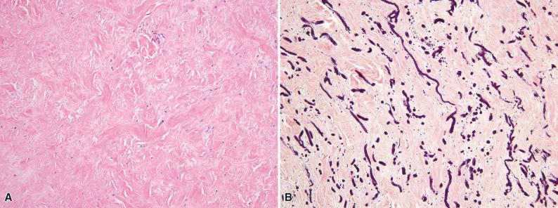 Figure 3.23, Elastofibroma.