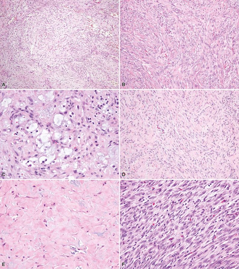 Figure 3.4, Nodular Fasciitis.