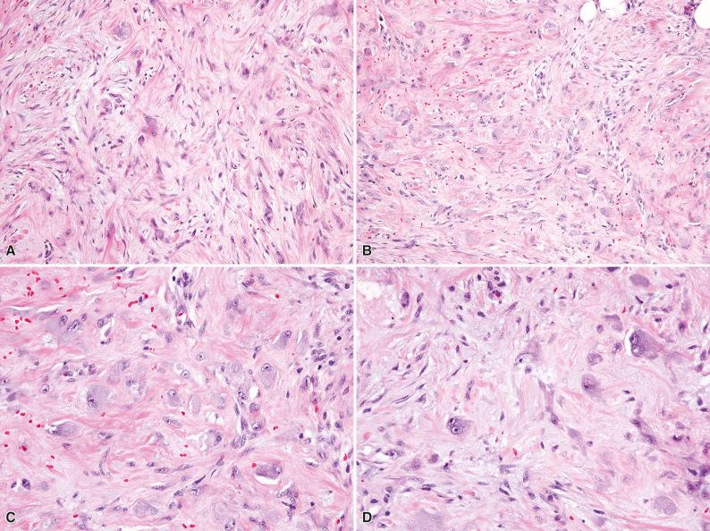 Figure 3.5, Proliferative Fasciitis.