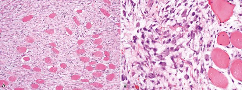 Figure 3.6, Proliferative Myositis.