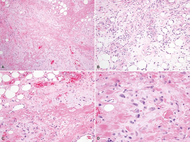 Figure 3.7, Ischemic Fasciitis.