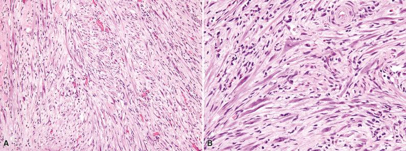 Figure 3.8, Pseudosarcomatous Myofibroblastic Proliferation.