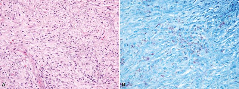 Figure 3.9, Mycobacterial Spindle Cell Pseudotumor.