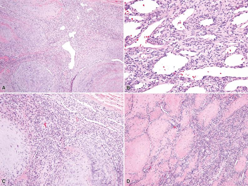 Figure 3.10, Myofibroma.