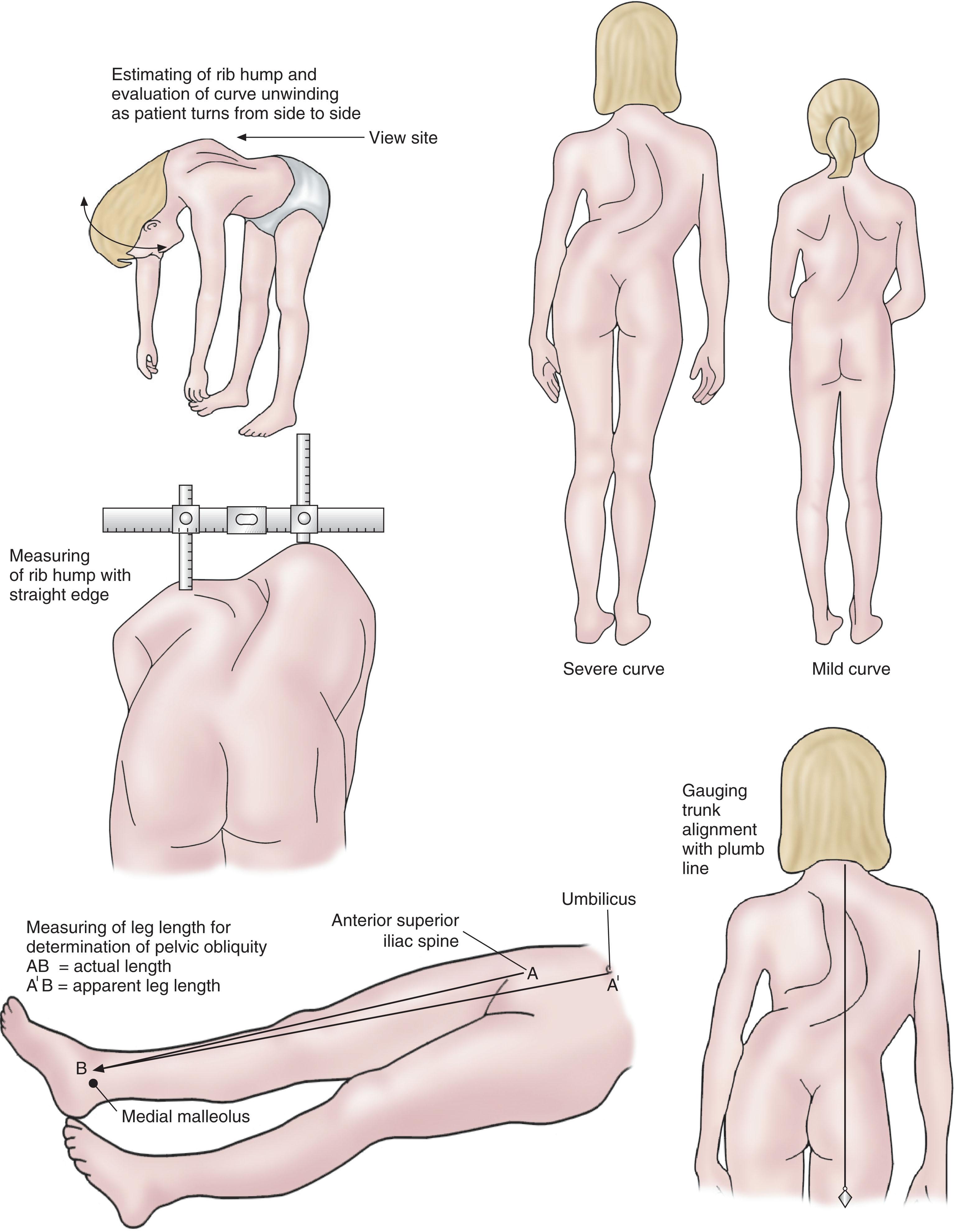 Figure 202.1, Clinical evaluation of a patient with scoliosis.