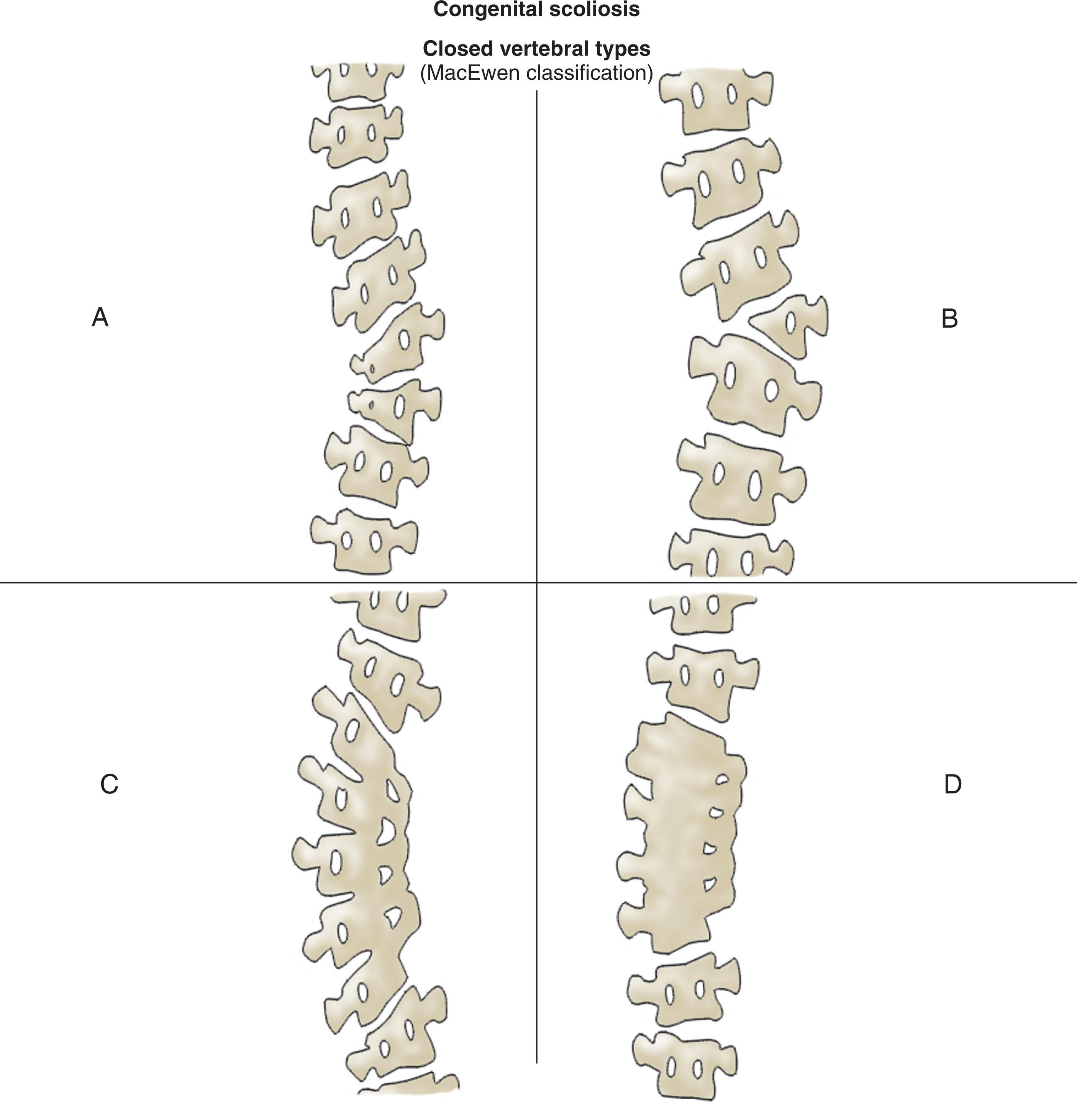 Figure 202.3, Types of closed vertebral and extravertebral spinal anomalies that result in congenital scoliosis. (A) Partial unilateral failure of formation (wedge vertebra). (B) Complete unilateral failure of formation (hemivertebra). (C) Unilateral failure of segmentation (congenital bar). (D) Bilateral failure of segmentation (block vertebra).