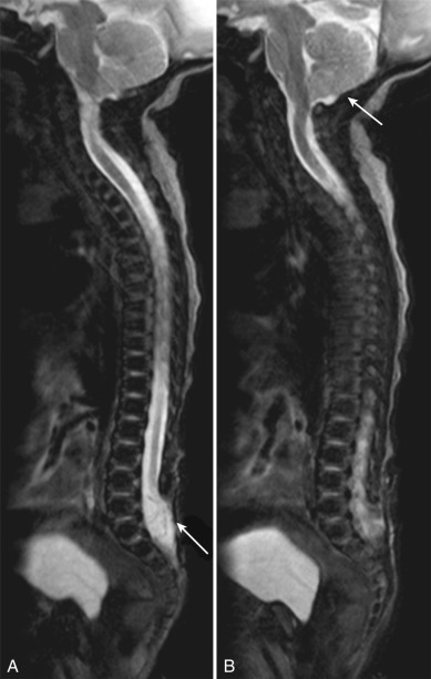 Figure 9.1, T2-weighted images at day 11 of life.