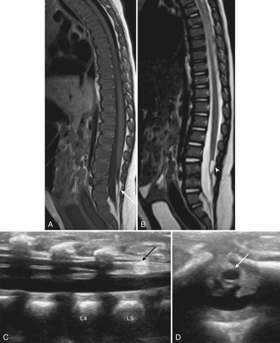 Figure 9.4, Fibrolipoma of the filum terminale.