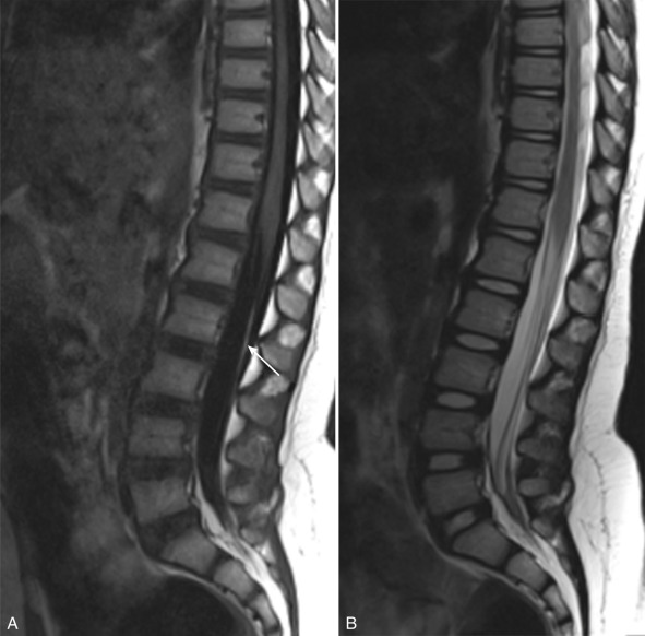 Figure 9.5, Filar lipoma ( arrow ) with normal position and configuration of the conus medullaris is shown on sagittal T1- ( A ) and T2-weighted ( B ) images.