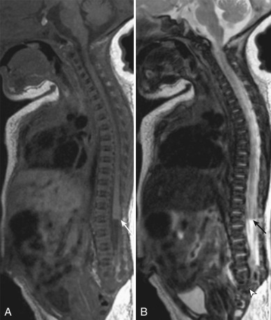 Figure 9.7, Caudal regression syndrome.