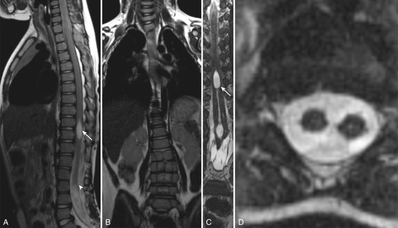 Figure 9.9, Diastematomyelia.